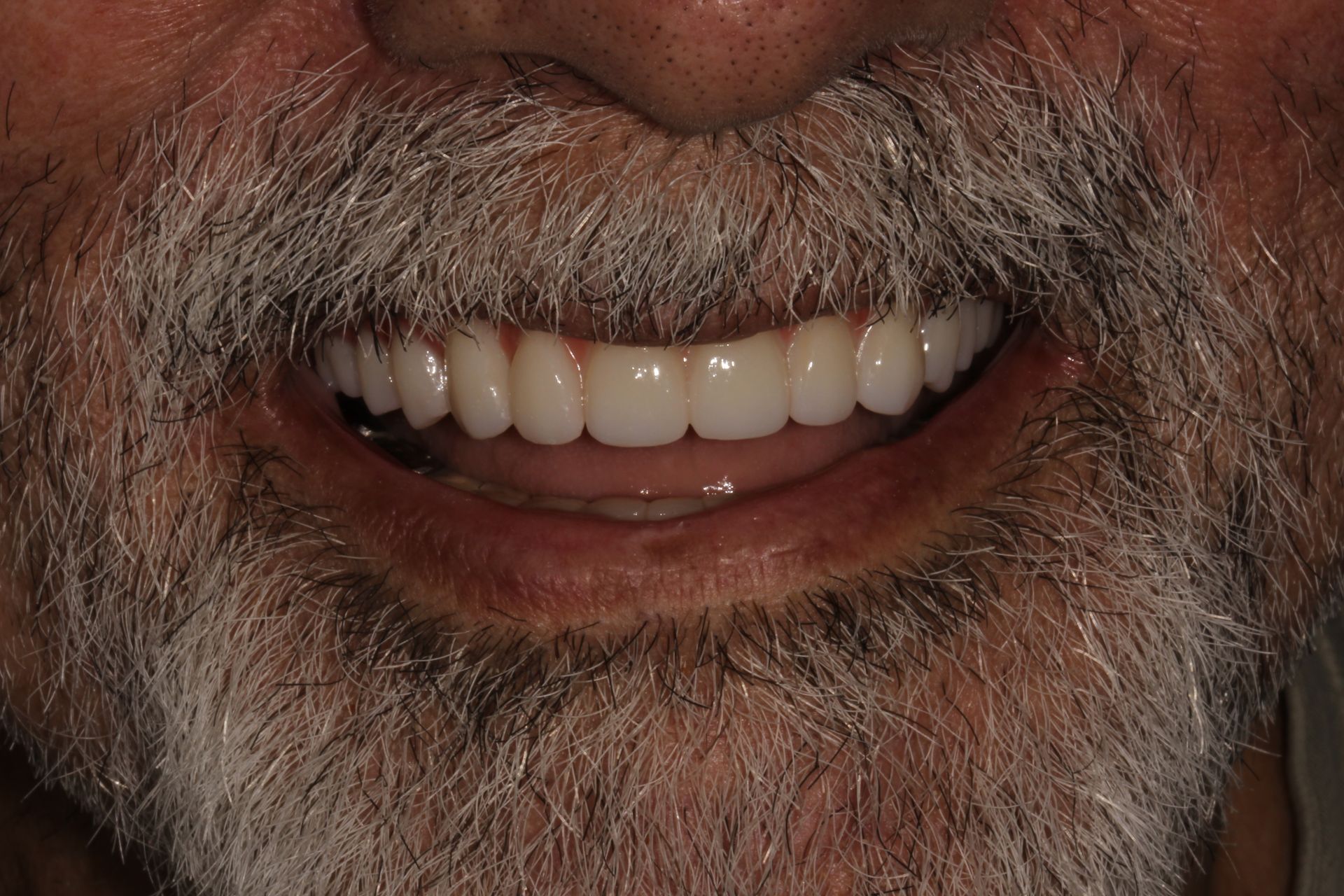 MAXILLARY FIXED HYBRID 5