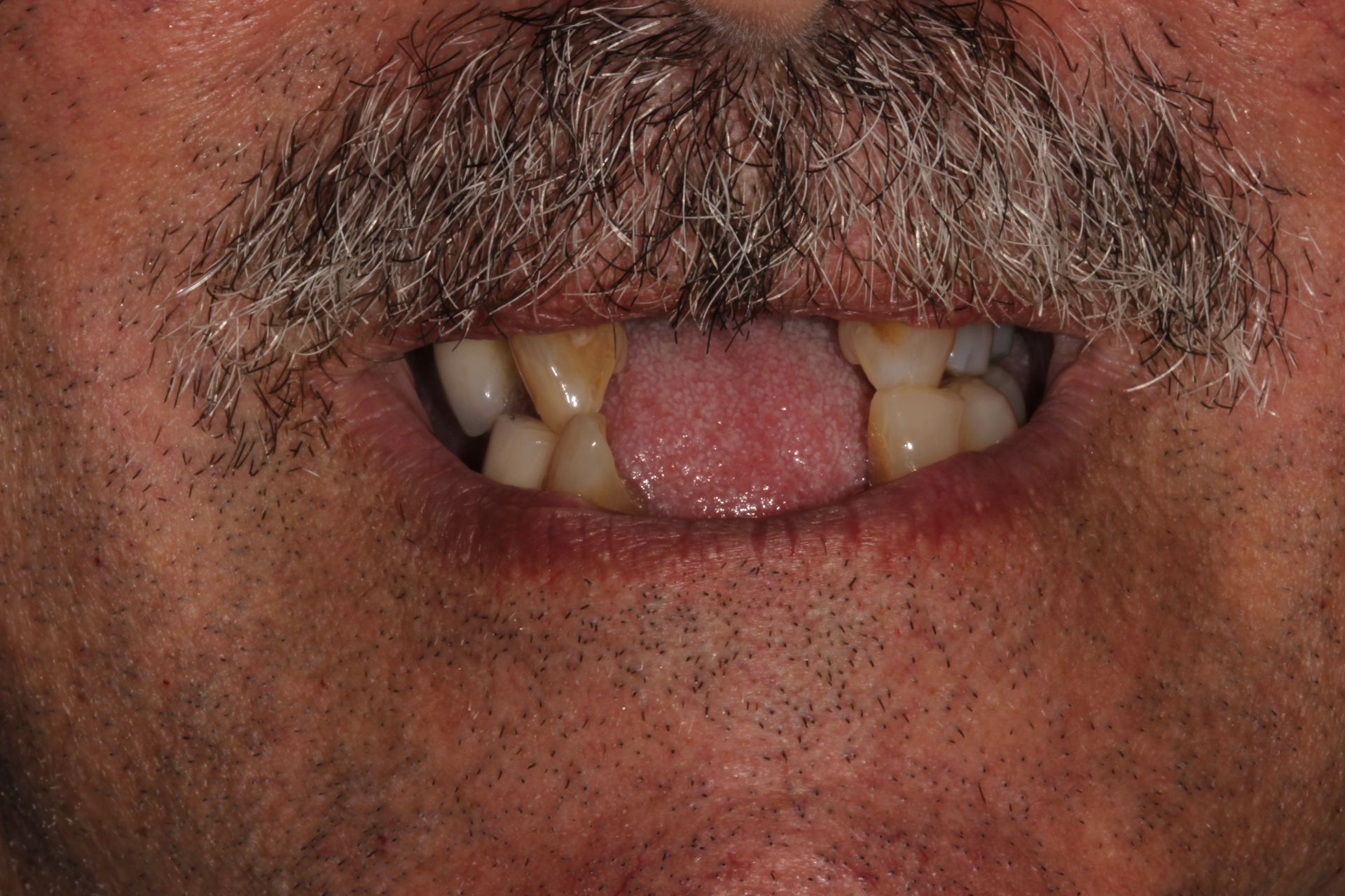 MAXILLARY FIXED HYBRID 3