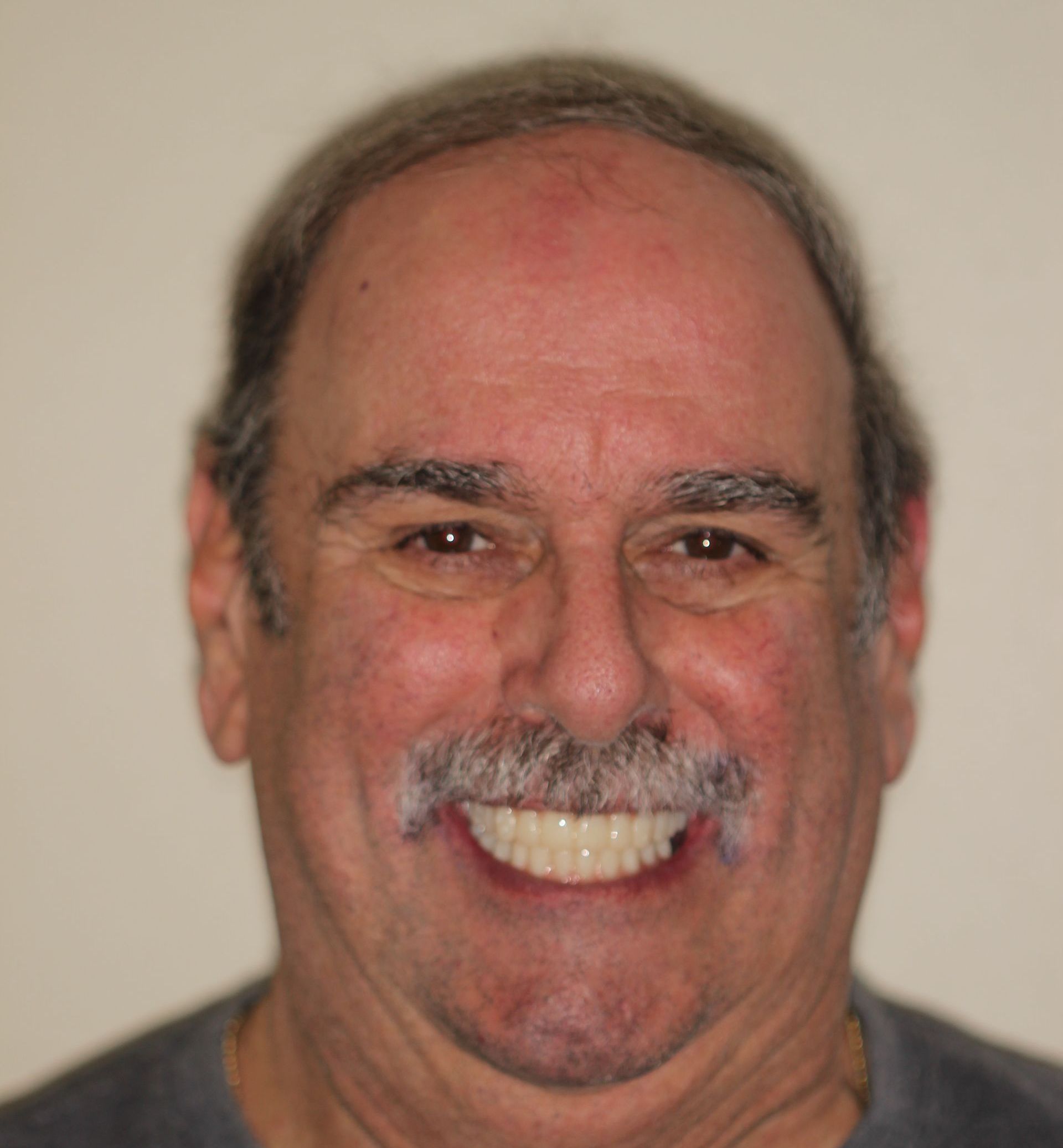 after dental implants, veneers, crowns | Dentists in Highland Park NJ 