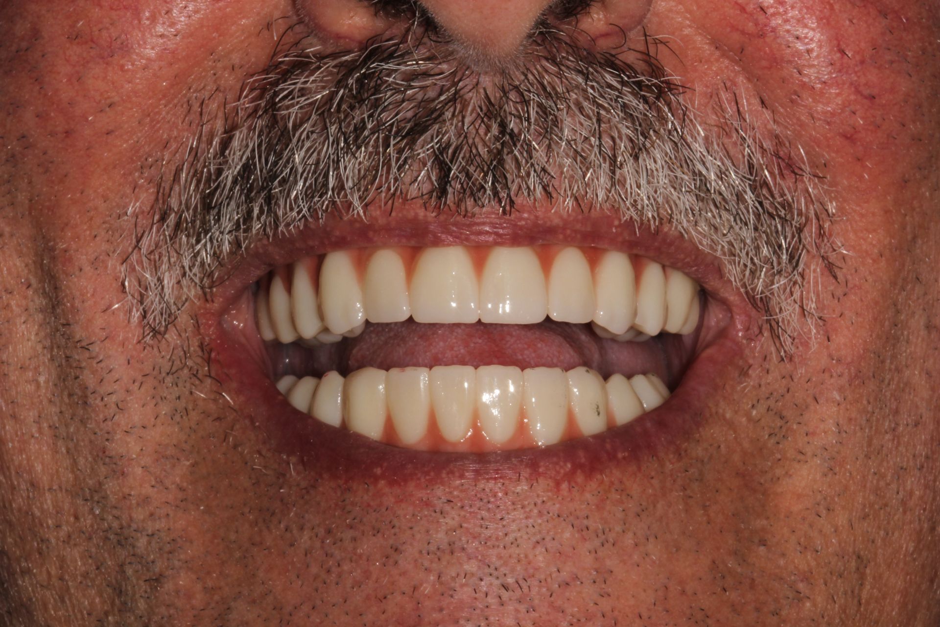 after smile makeover, veneers and teeth whitening by our dentist in Monroe township NJ