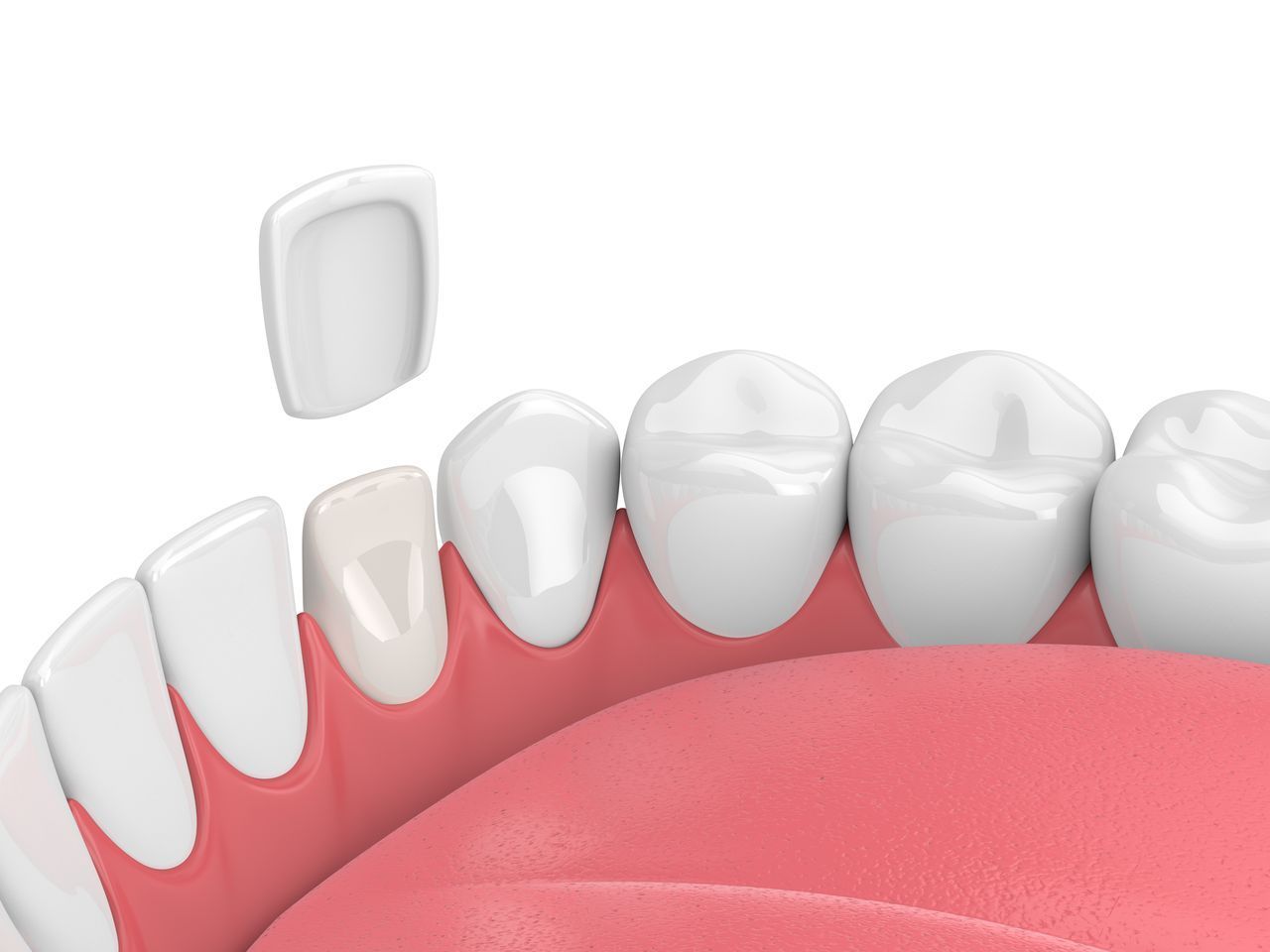 CEREC crown