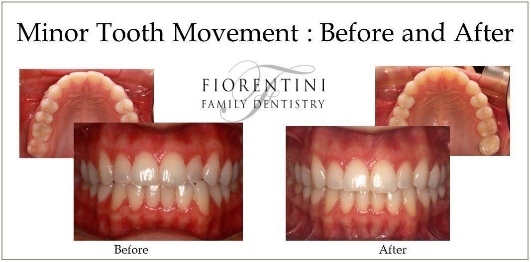 INVISALIGN before and after treatment | Get straight teeth with clear aligners in Monroe 08831 and Highland Park NJ 08904