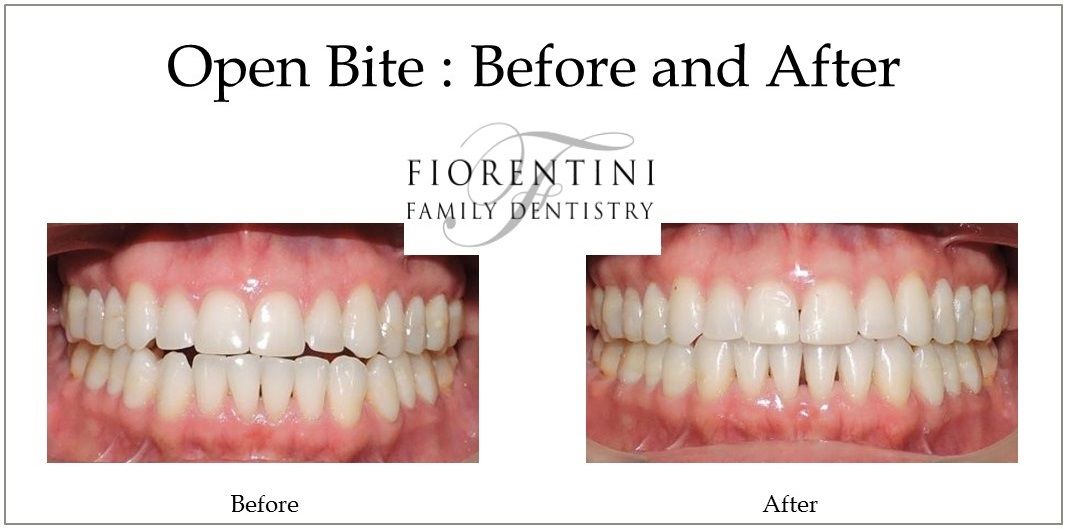 INVISALIGN before and after treatment | Get straight teeth with clear aligners in Monroe 08831 and Highland Park NJ 08904