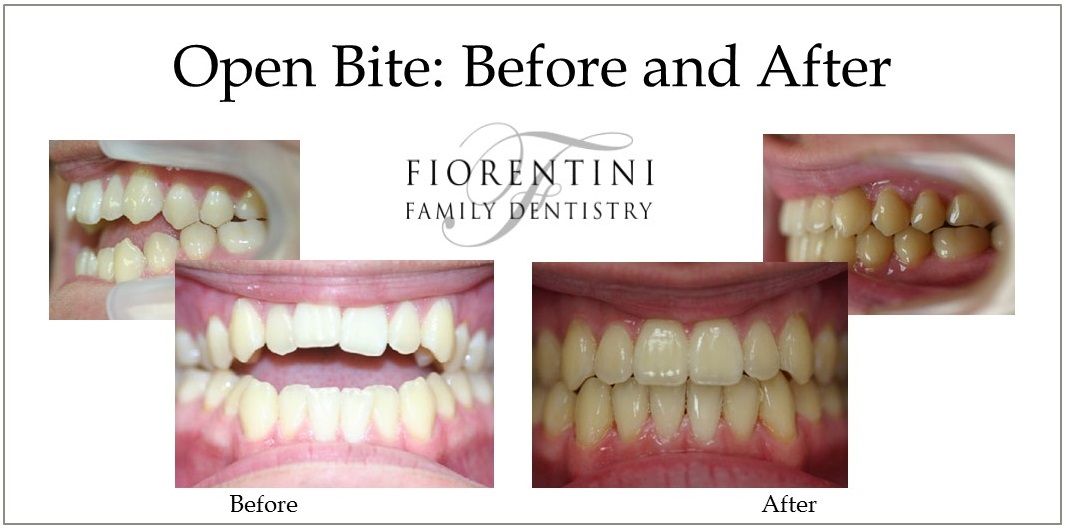 INVISALIGN before and after | dentists in Monroe 08831 and Highland Park NJ 08904