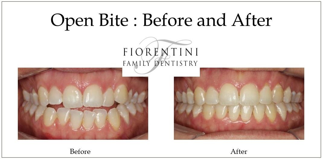 INVISALIGN before and after treatment | Get straight teeth with clear aligners in Monroe 08831 and Highland Park NJ 08904