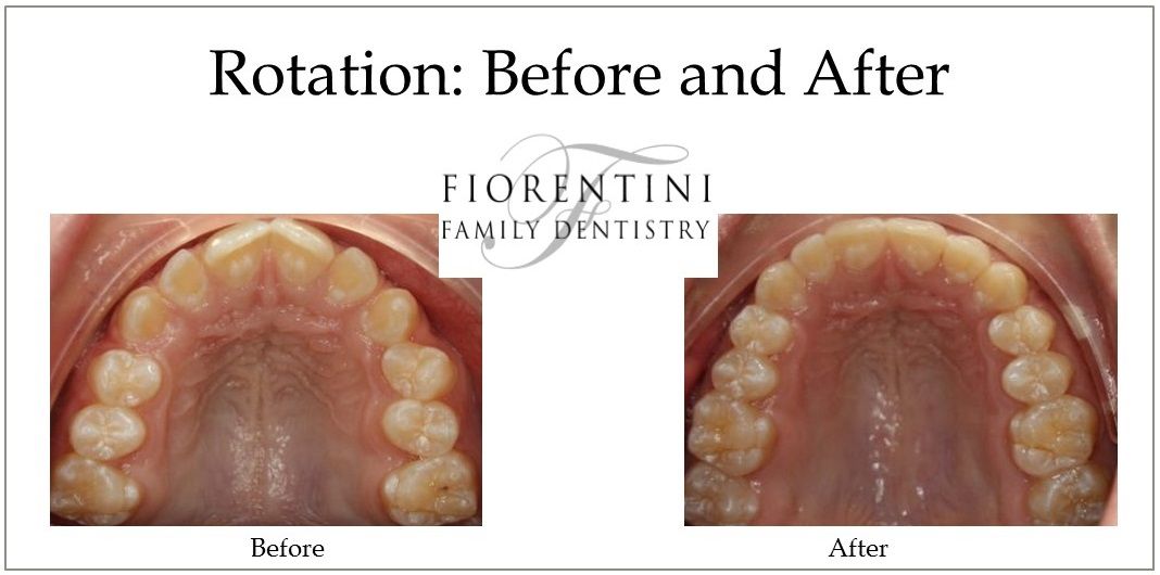 INVISALIGN before and after treatment | Get straight teeth with clear aligners in Monroe 08831 and Highland Park NJ 08904