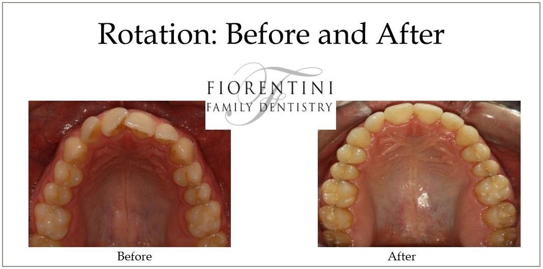 INVISALIGN before and after photos | top dentists in highland park and Monroe Township nj 