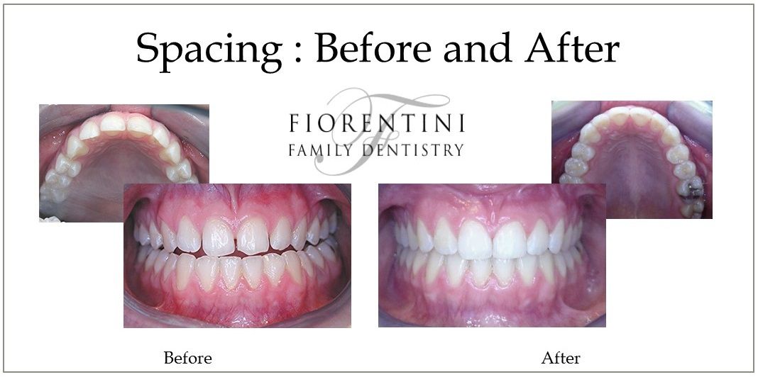 INVISALIGN | before and after photos | Top dentists in Monroe and Highland Park NJ