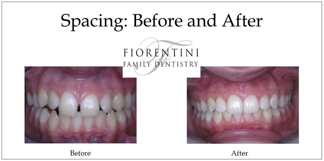 INVISALIGN before and after treatment | Get straight teeth with clear aligners in Monroe 08831 and Highland Park NJ 08904