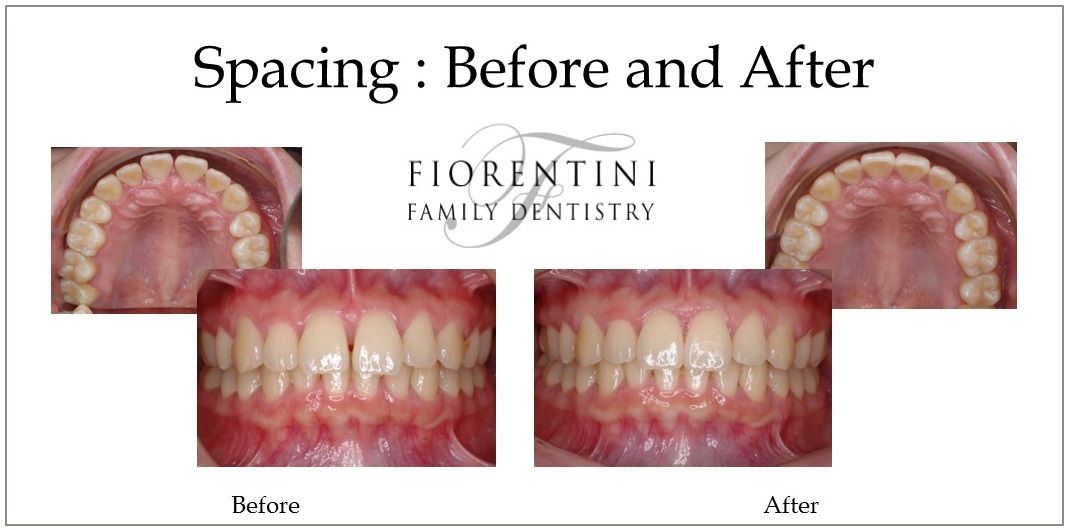 Fixing spacing | Dentists near Highland Park and Monroe Township NJ 