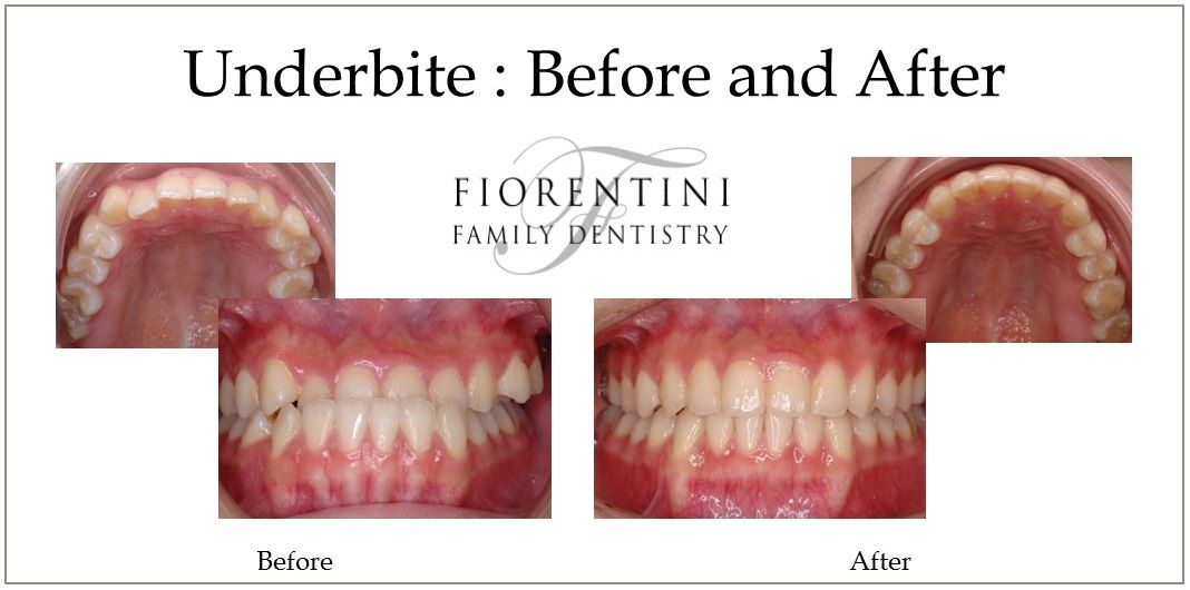 Underbite before and after | Best family dentist Highland Park and Monroe Township NJ