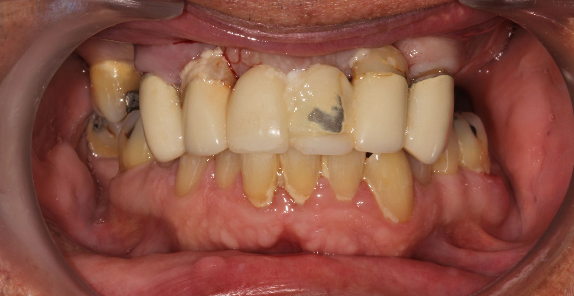 Before dental veneers and cleaning in Monroe Township and Highland Park NJ