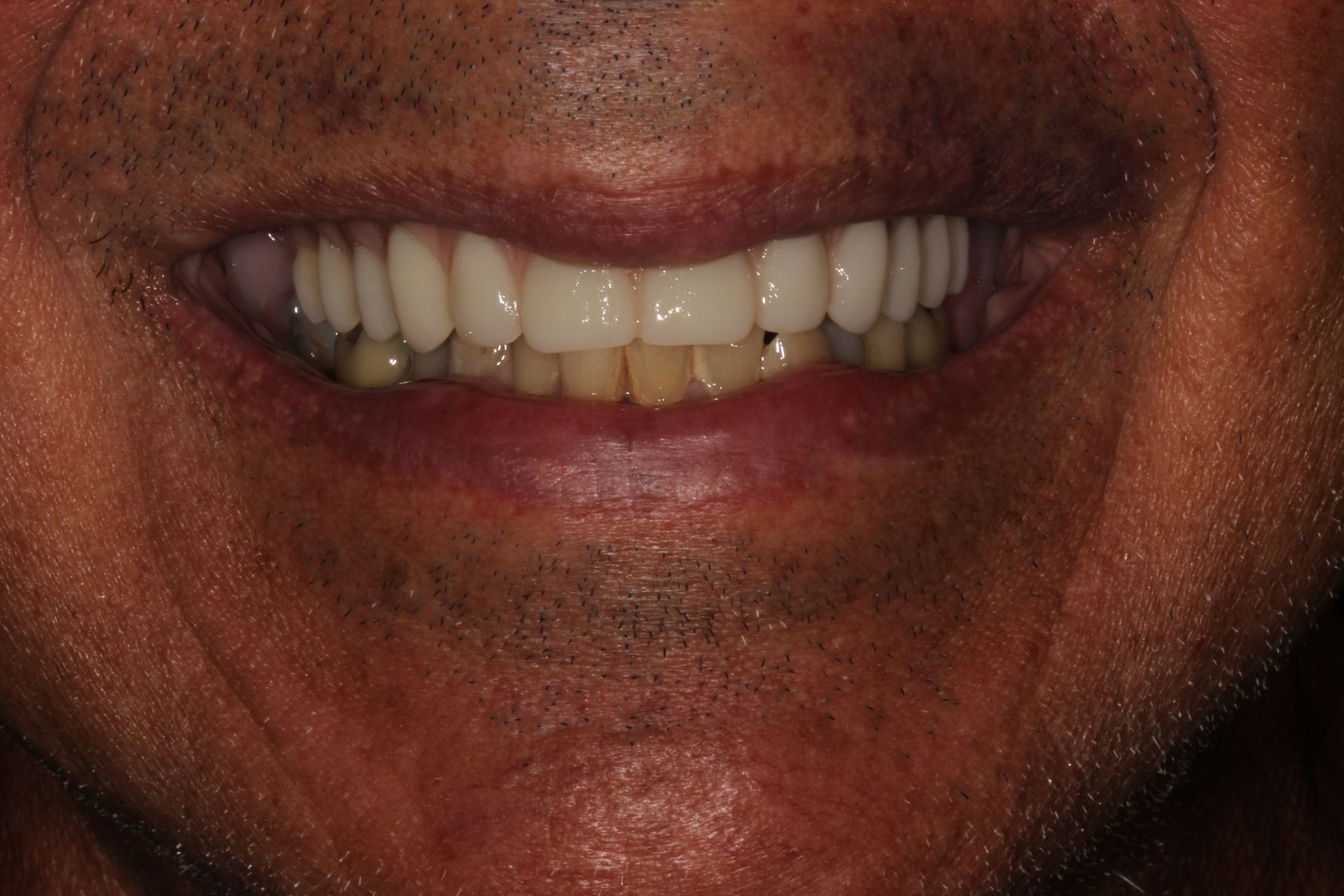 MAXILLARY FIXED HYBRID 4