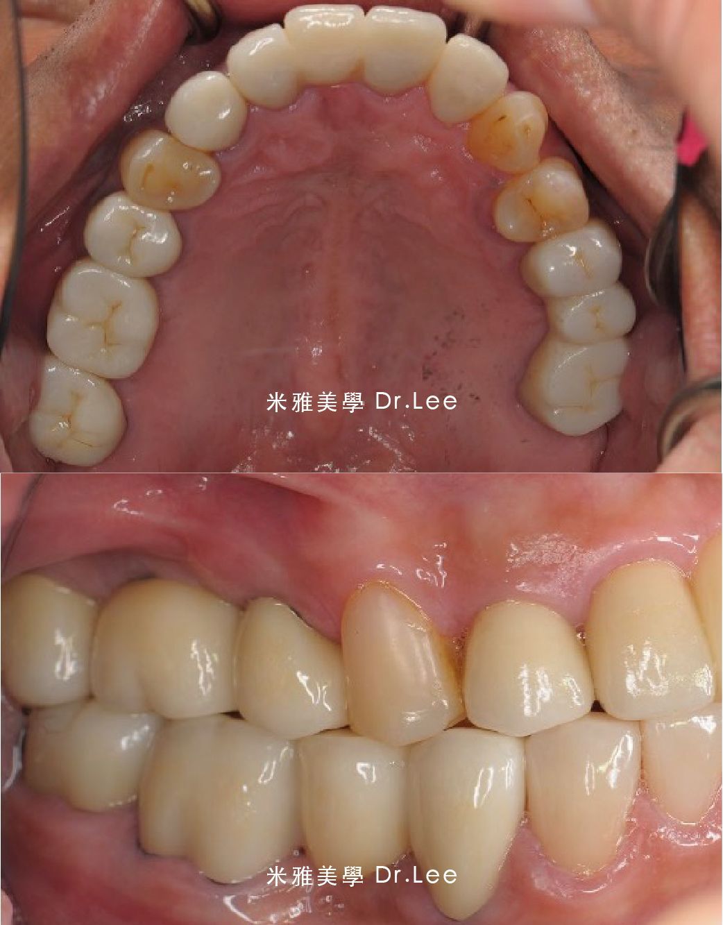 A picture of a person 's teeth before and after dental work