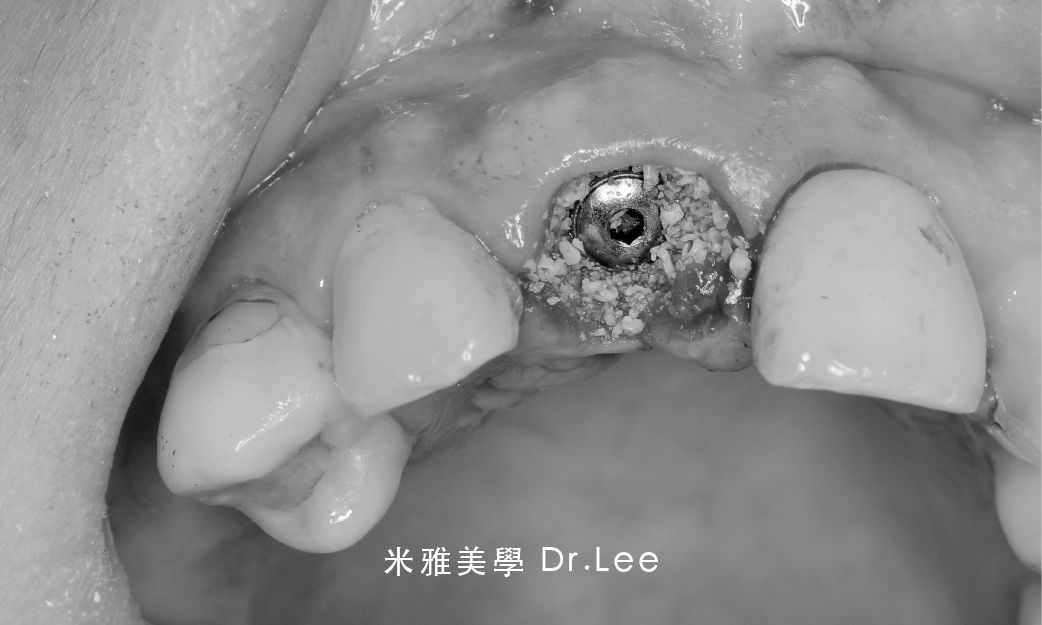 A black and white photo of a person 's mouth with a hole in it.