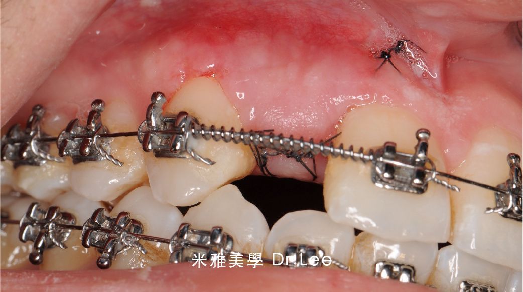 A close up of a person 's mouth with braces on their teeth.