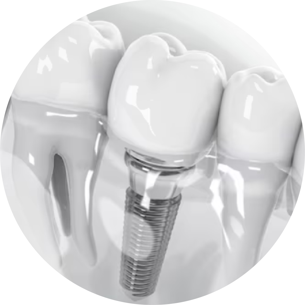 A close up of a dental implant between two teeth.