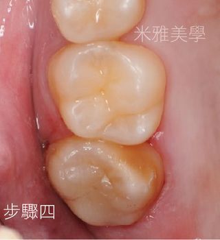 A close up of a tooth with chinese writing on it