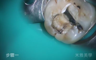 A close up of a tooth with a hole in it on a green surface.