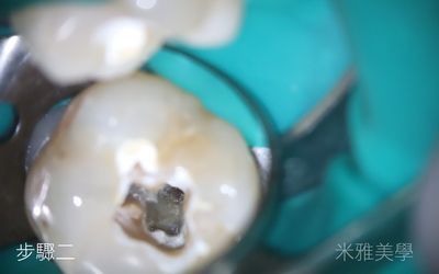 A close up of a tooth with a hole in it