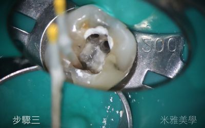 A close up of a tooth being examined by a dentist.