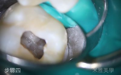 A close up of a tooth with a hole in it