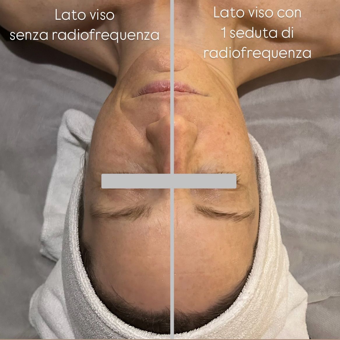 Confronto di un viso, con un lato sottoposto a trattamento a radiofrequenza, che mostra un potenziale miglioramento della pelle.