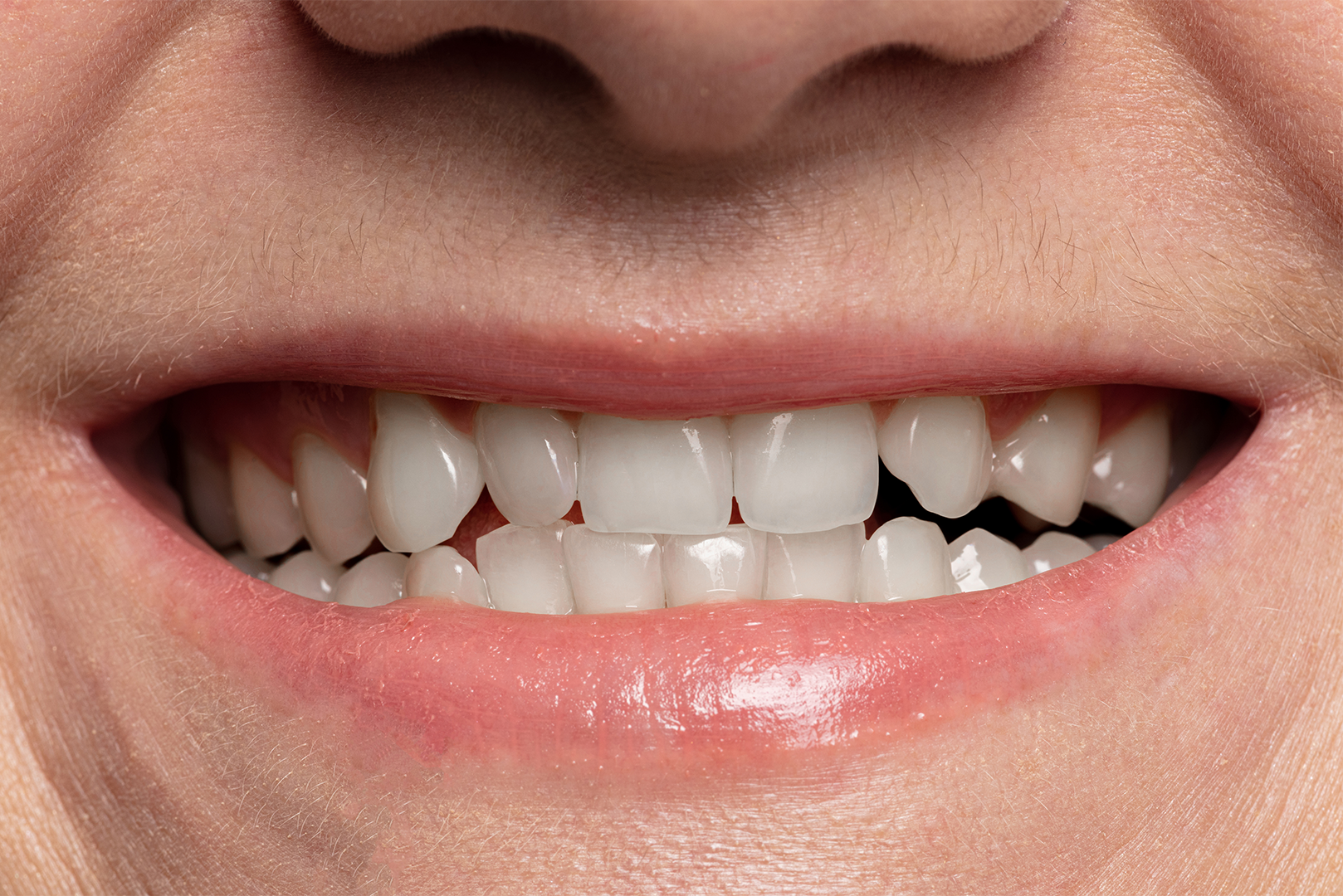 A close up of a person 's mouth with a broken tooth.