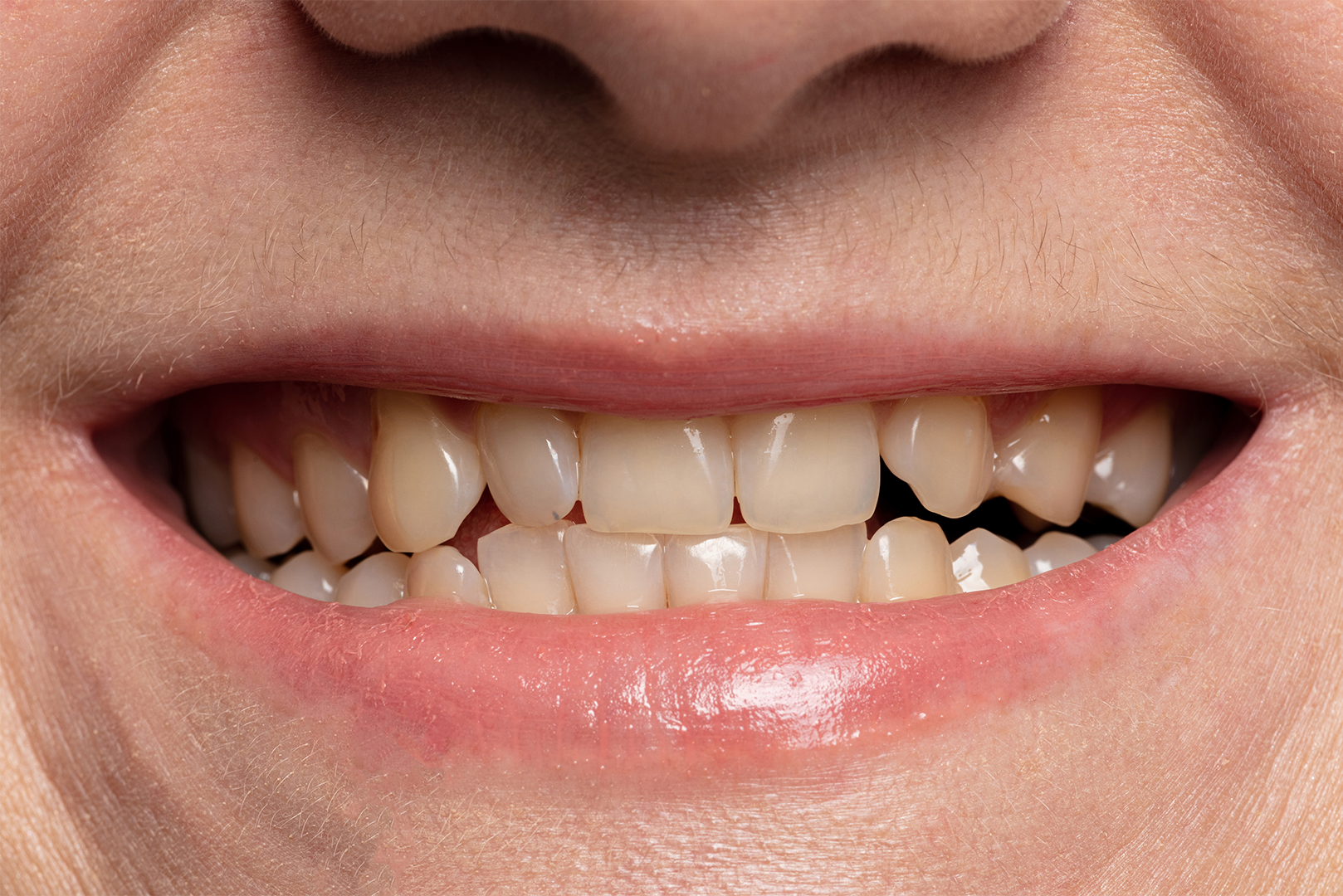 A close up of a man 's mouth with a broken tooth.