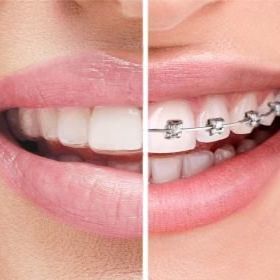 Close-up of a mouth with misaligned teeth on the left, and teeth with metal braces on the right.