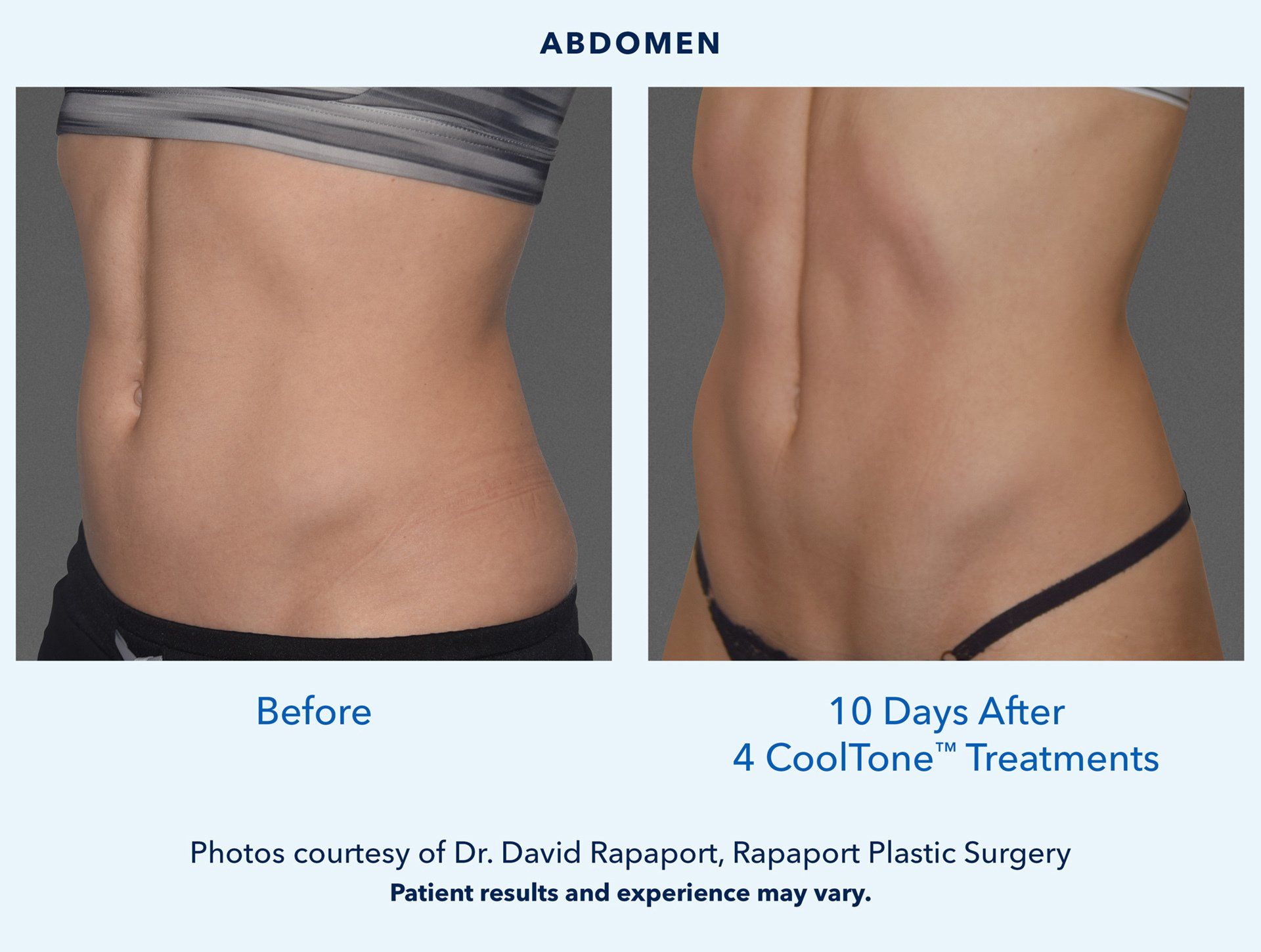 CoolTone before and after treatment photo abdomen buttocks