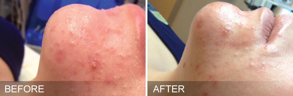 Hydrafacial before and after photos