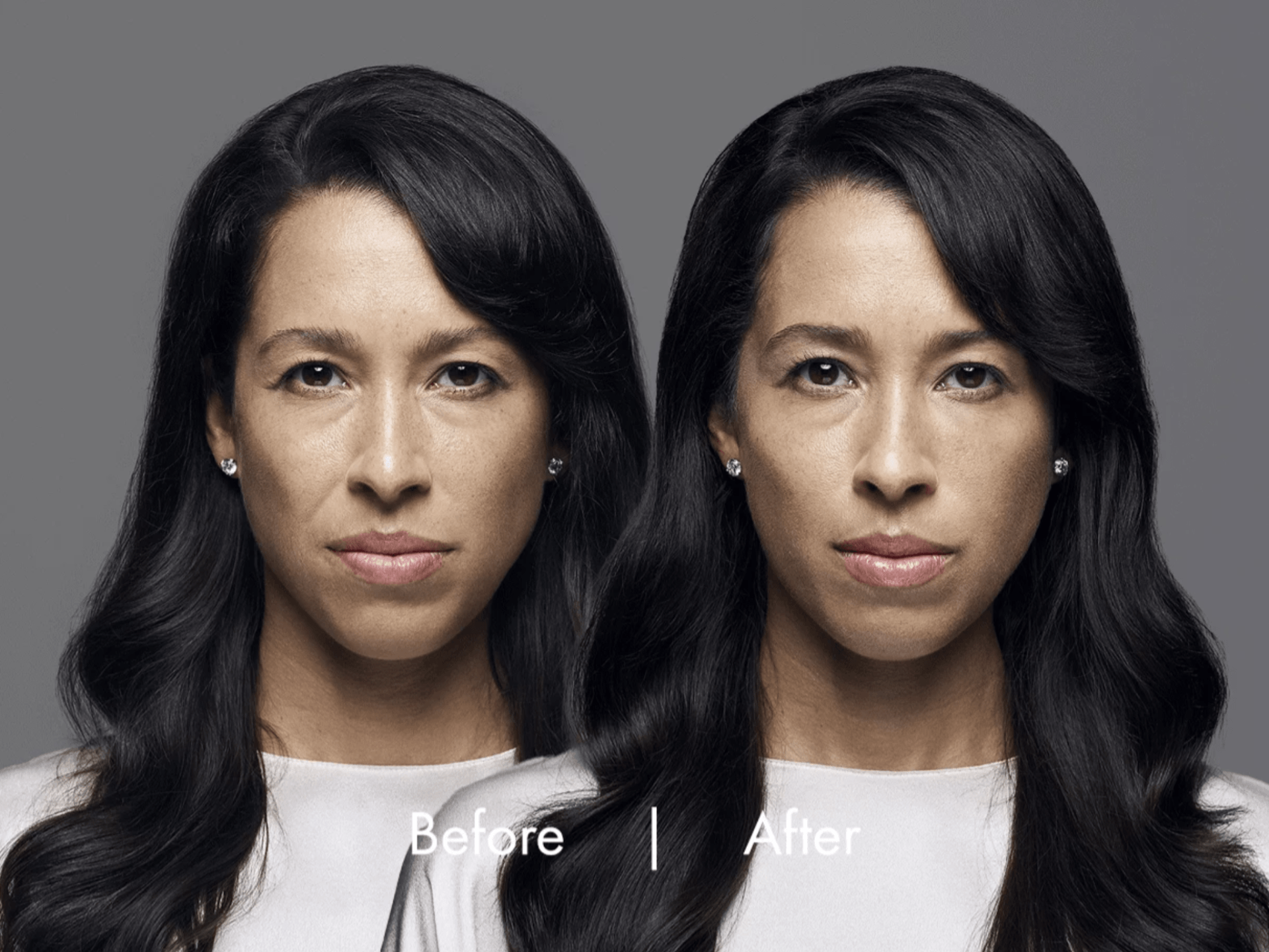 before and after RHA filler treatment