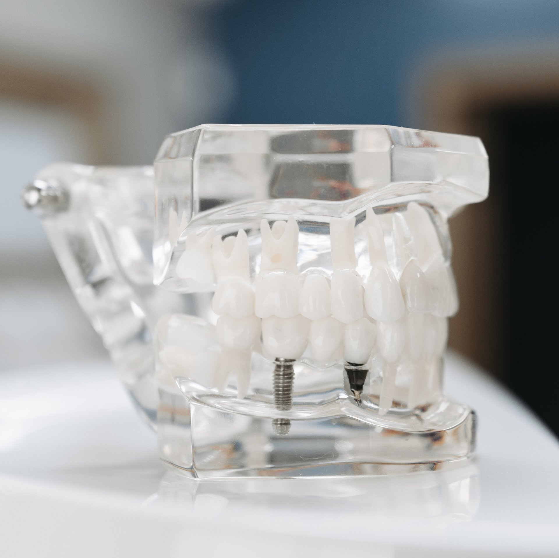 Dental implant at Rand Dental - featured services
