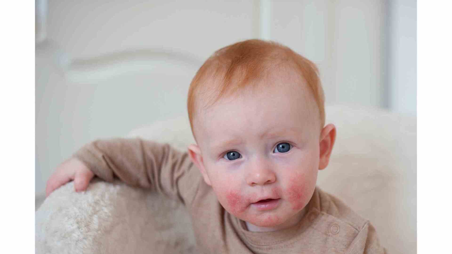 alergia em bebe