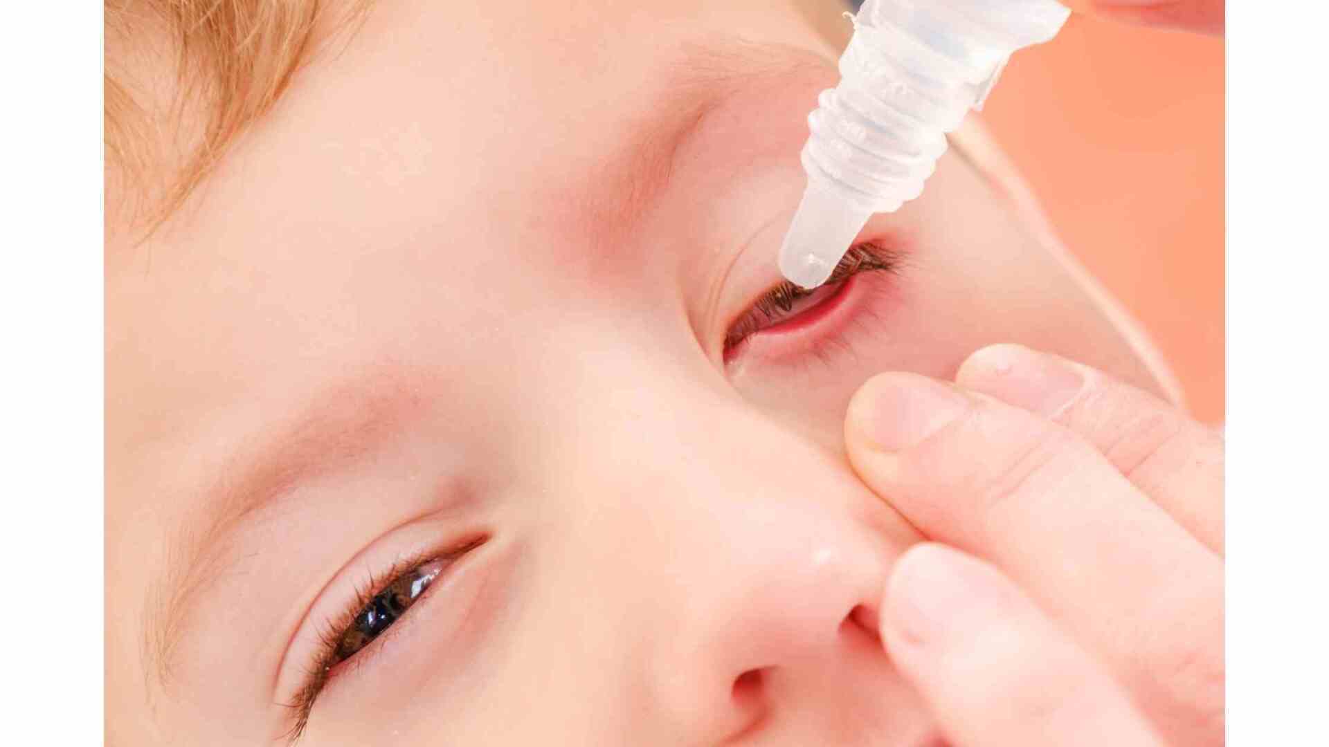 criança com conjuntivite alérgica sendo tratada com colírio