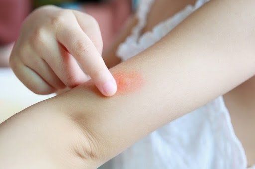 Como saber se tenho alergia a picada de mosquito?