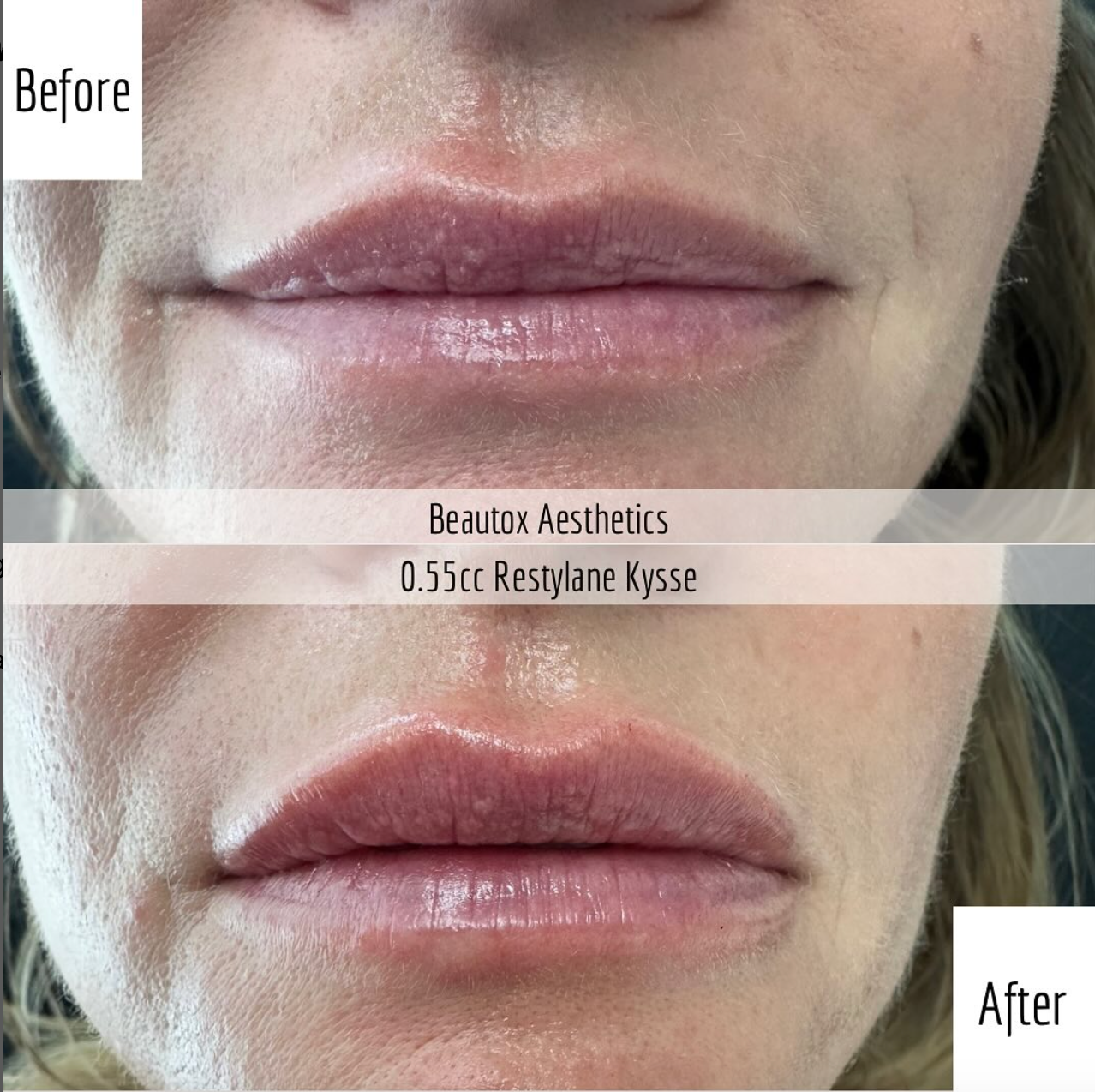 A before and after photo of a woman 's lips by beauton aesthetics