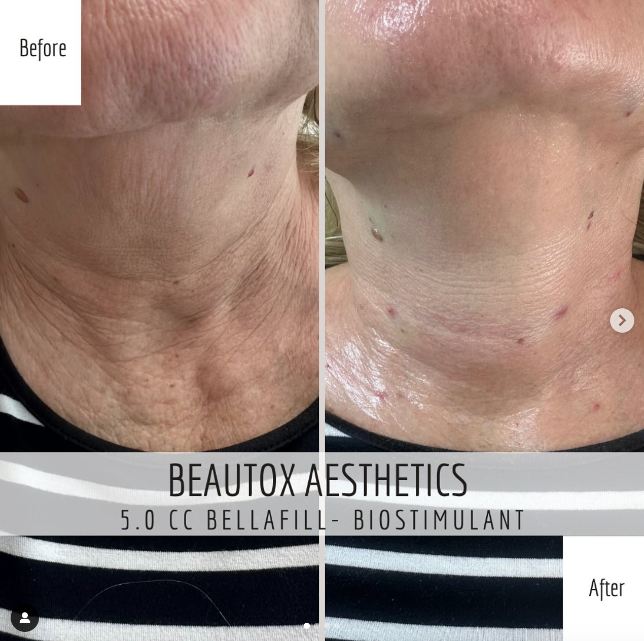 A before and after photo of a woman 's neck and face