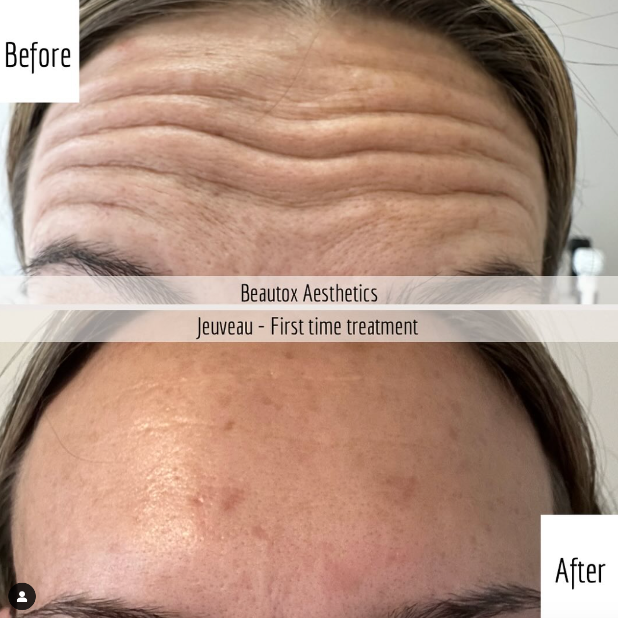A before and after photo of a woman 's forehead.