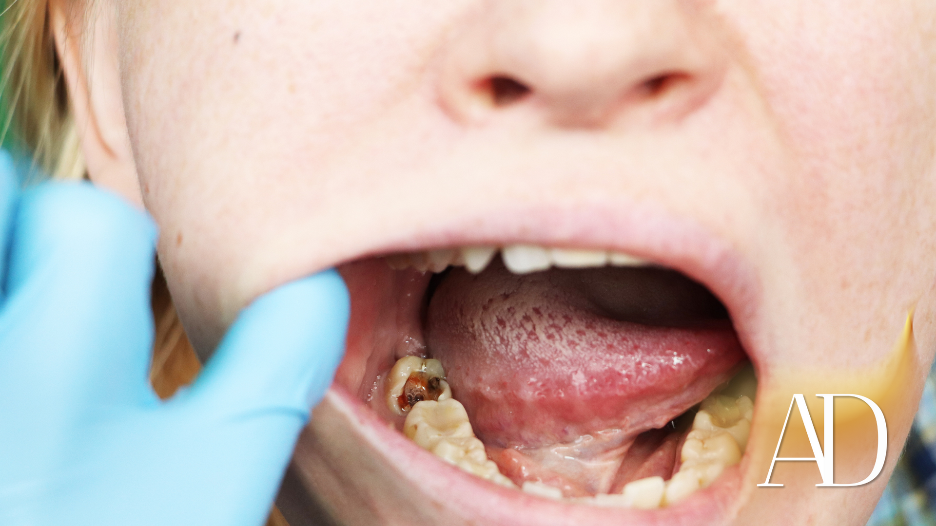 A woman is getting her teeth examined by a dentist.