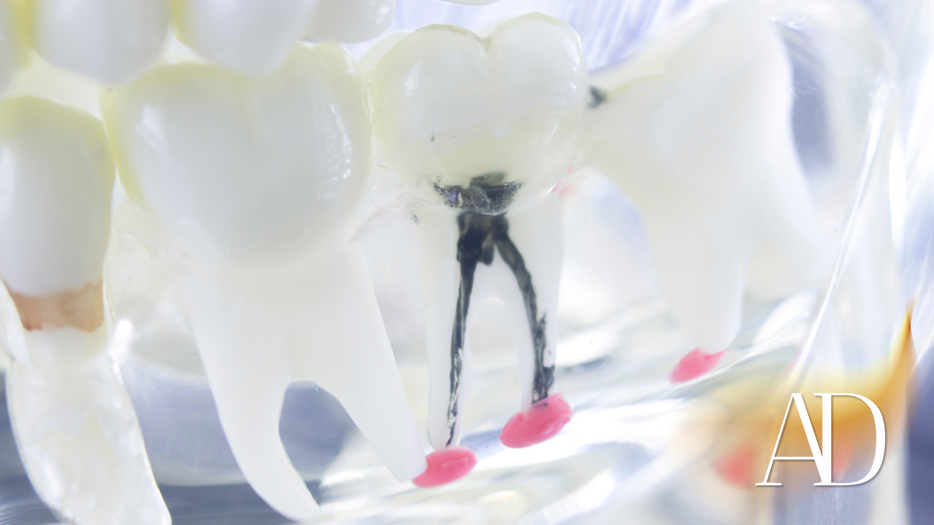 A close up of a model of a tooth with a hole in it.