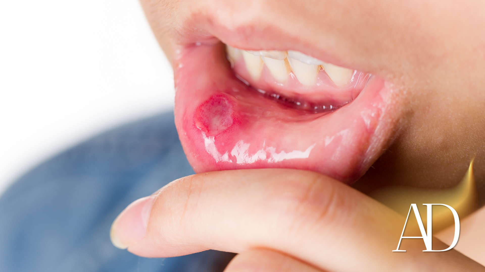 A close up of a person 's mouth with a red spot on it.