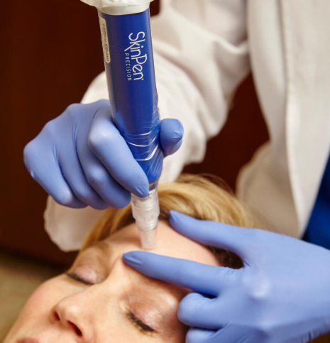 Woman with skinPen precision microneedling treatment applied to forehead