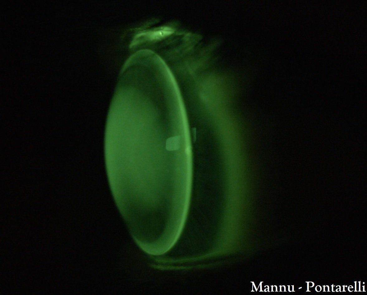 Lente a contatto rgp