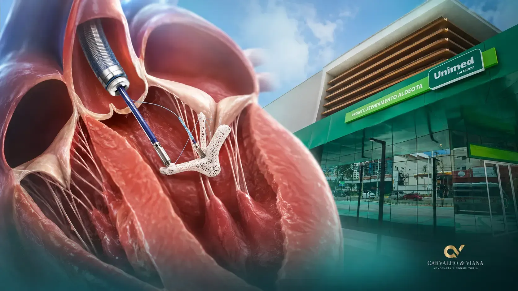 Unimed Fortaleza MitraClip