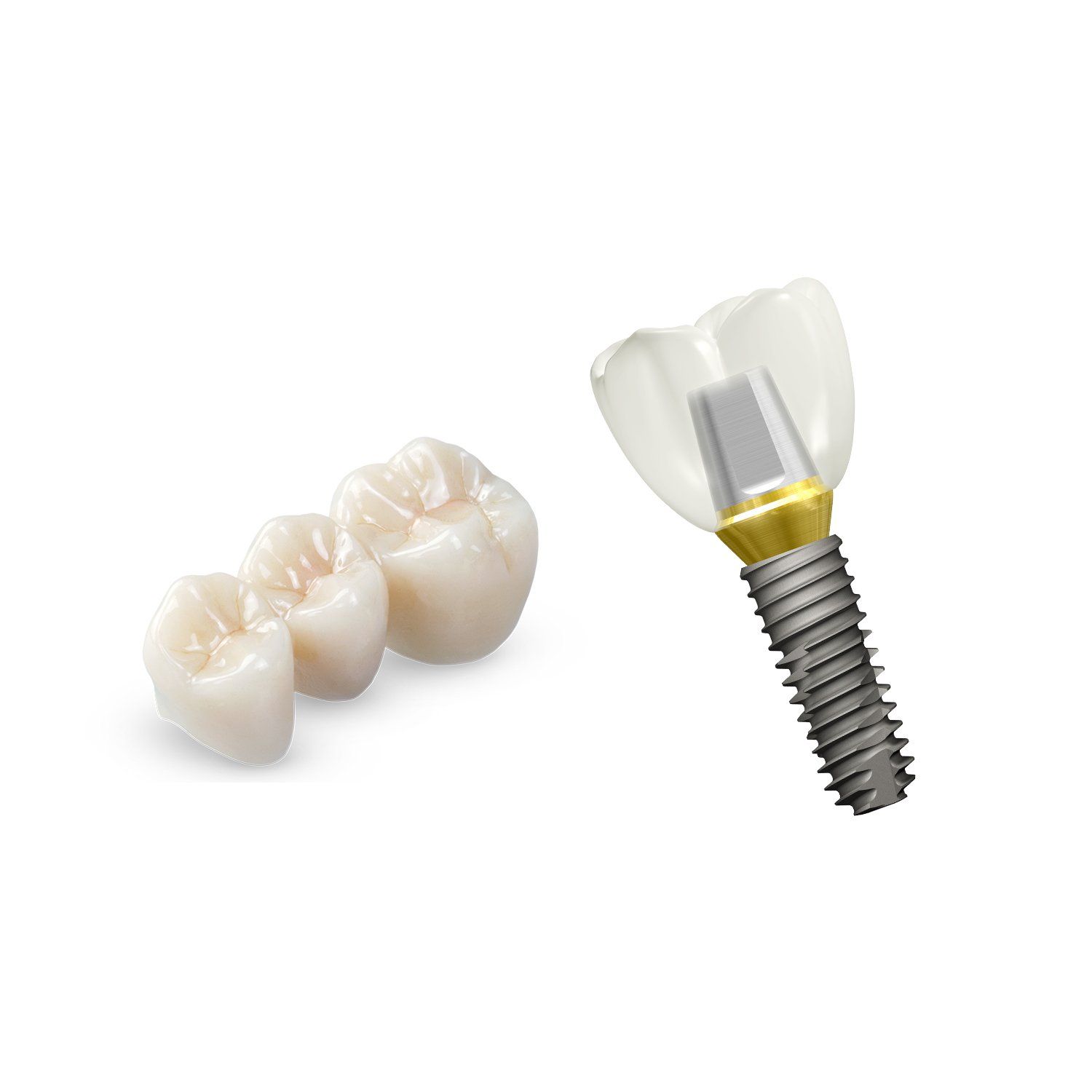 impianti dentali in Albania