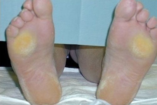malattie unghie e piedi