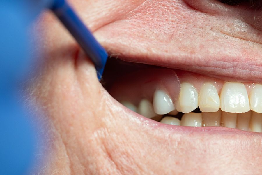 A Close-up Of a Person's Teeth Being Examined by A Dentist — Cane to Coast Dentures in Sarina, QLD
