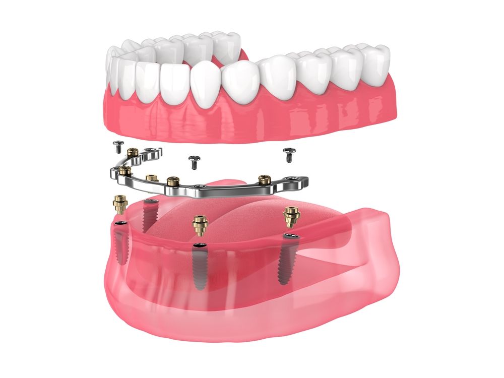 A Model of A Mouth with Dental Implants in It — Cane to Coast Dentures in Sarina, QLD
